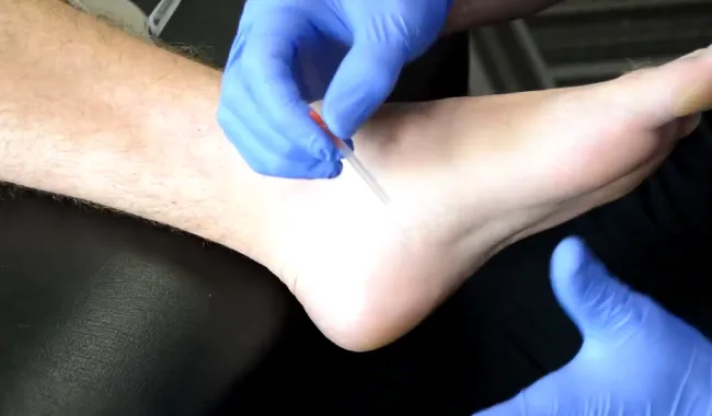 How long does dry needling take to resolve hiking related plantar fasciitis