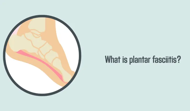 What Are the Symptoms of Plantar Fasciitis: 5 Indications