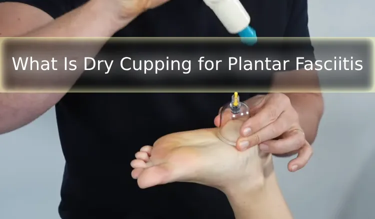 What Is Dry Cupping for Plantar Fasciitis